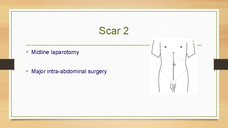 Scar 2 • Midline laparotomy • Major intra-abdominal surgery 