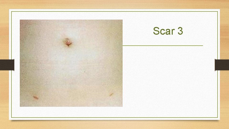 Scar 3 