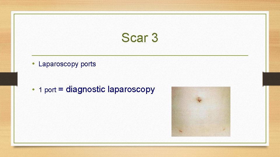 Scar 3 • Laparoscopy ports • 1 port = diagnostic laparoscopy 