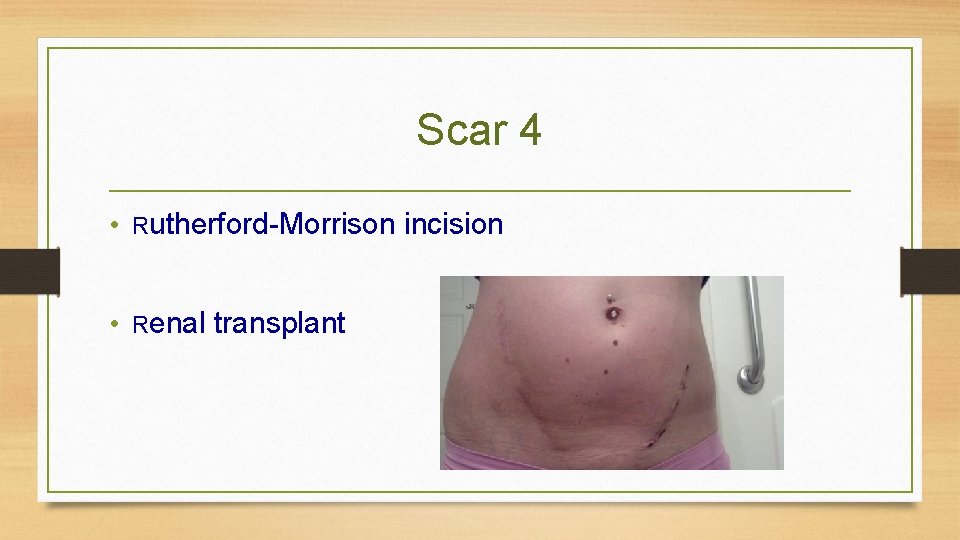 Scar 4 • Rutherford-Morrison incision • Renal transplant 