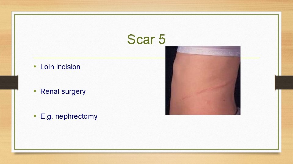 Scar 5 • Loin incision • Renal surgery • E. g. nephrectomy 