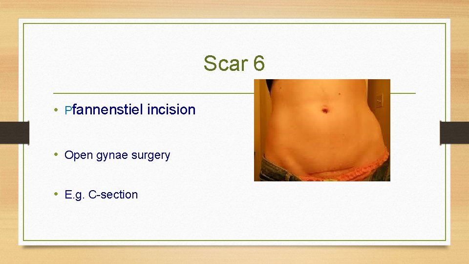Scar 6 • Pfannenstiel incision • Open gynae surgery • E. g. C-section 