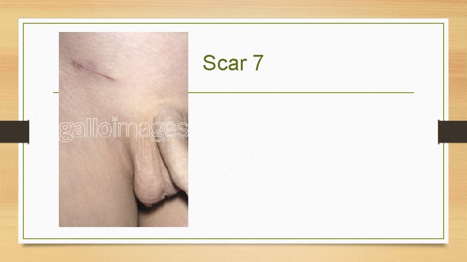Scar 7 