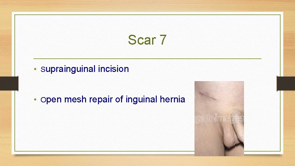 Scar 7 • Suprainguinal incision • Open mesh repair of inguinal hernia 