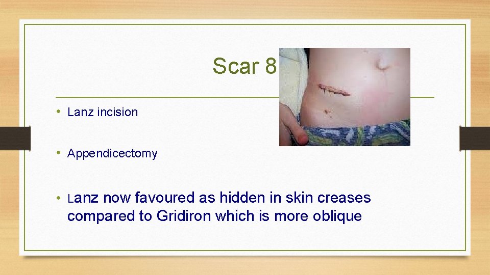 Scar 8 • Lanz incision • Appendicectomy • Lanz now favoured as hidden in