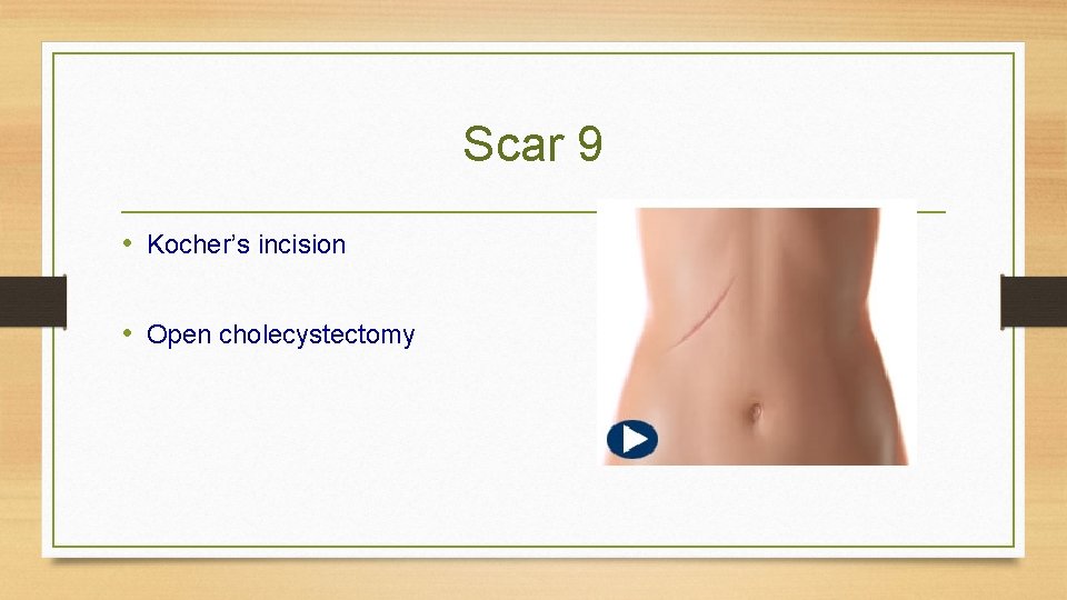 Scar 9 • Kocher’s incision • Open cholecystectomy 