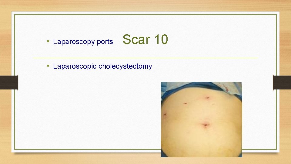  • Laparoscopy ports Scar 10 • Laparoscopic cholecystectomy 