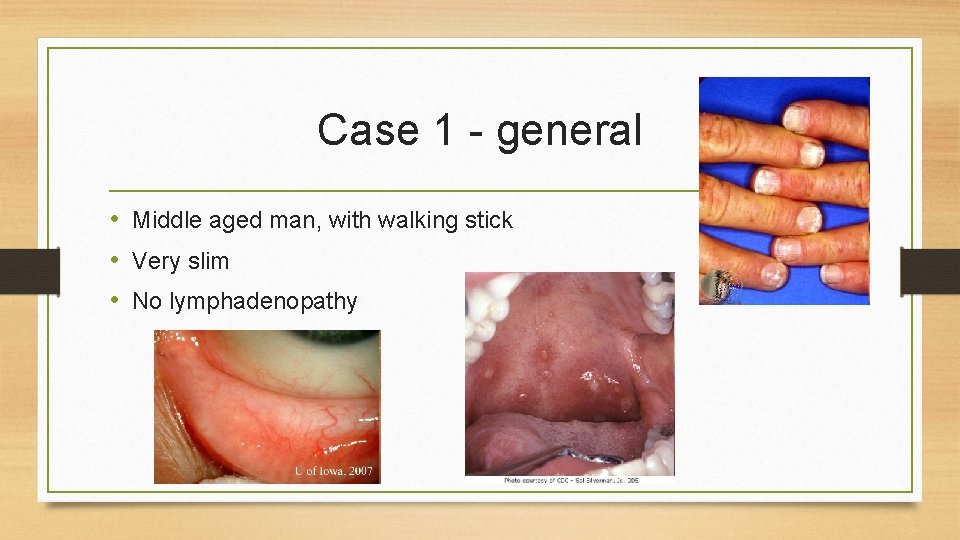 Case 1 - general • Middle aged man, with walking stick • Very slim
