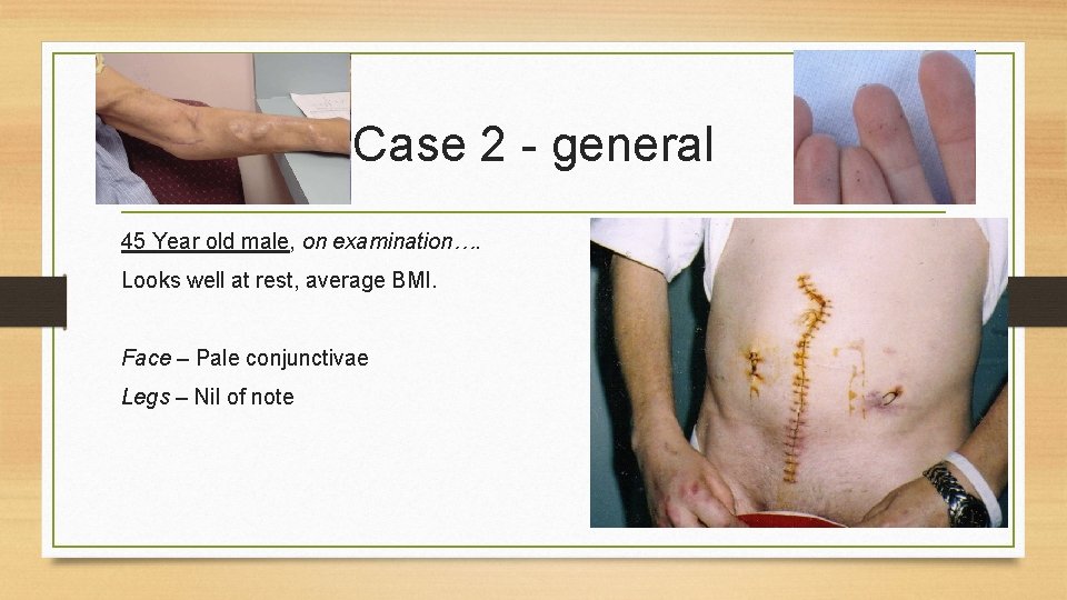 Case 2 - general 45 Year old male, on examination…. Looks well at rest,