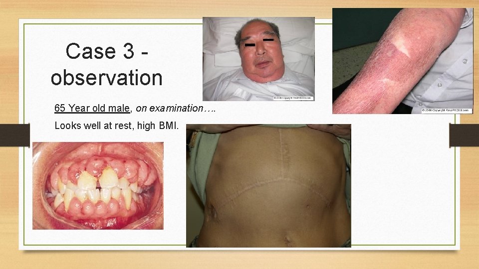 Case 3 observation Case 2 65 Year old male, on examination…. Looks well at