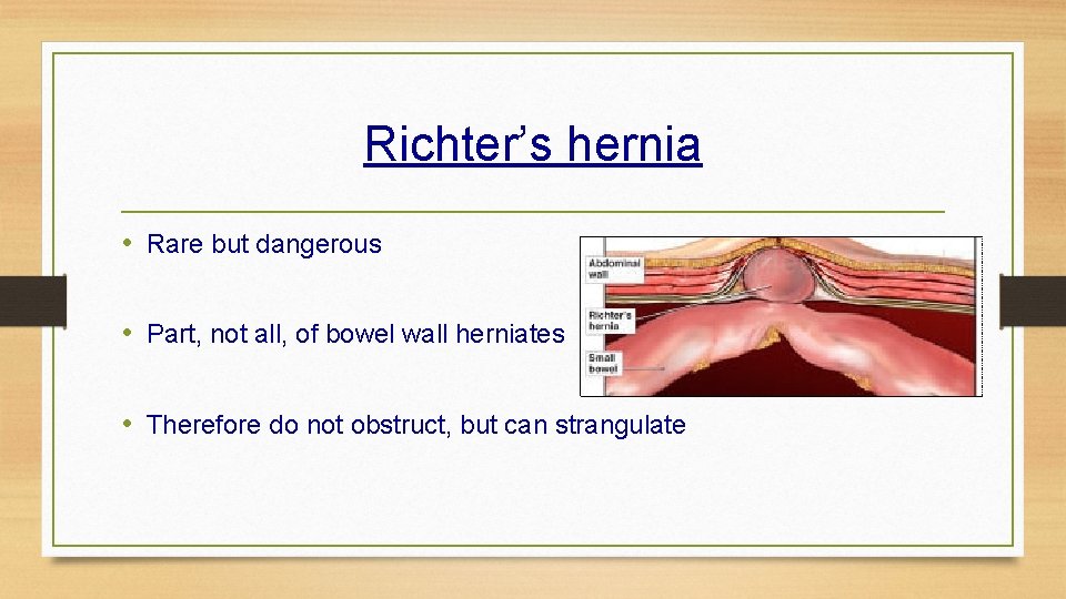 Richter’s hernia • Rare but dangerous • Part, not all, of bowel wall herniates