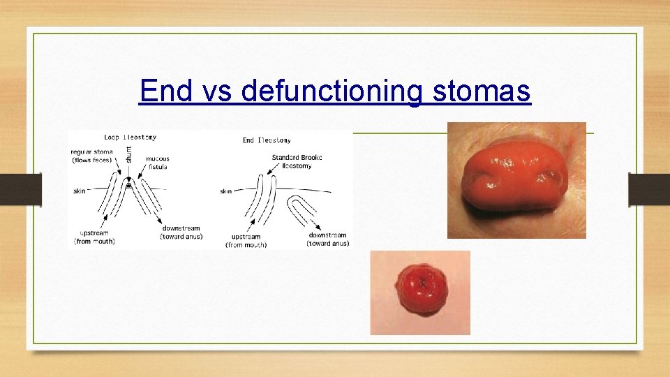End vs defunctioning stomas 