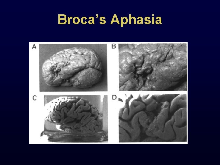 Broca’s Aphasia 