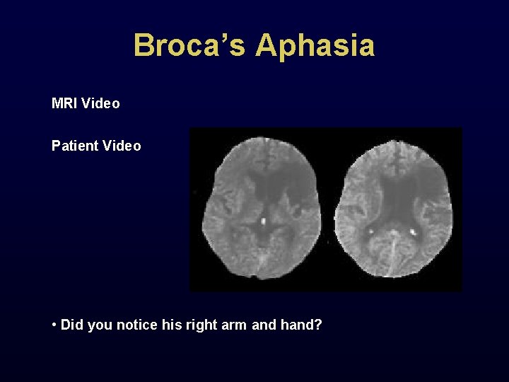Broca’s Aphasia MRI Video Patient Video • Did you notice his right arm and