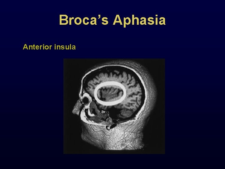 Broca’s Aphasia Anterior insula 