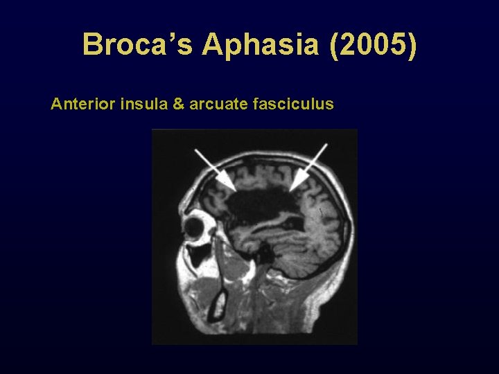 Broca’s Aphasia (2005) Anterior insula & arcuate fasciculus 