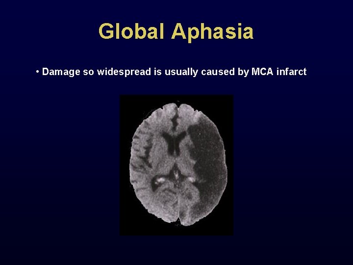 Global Aphasia • Damage so widespread is usually caused by MCA infarct 