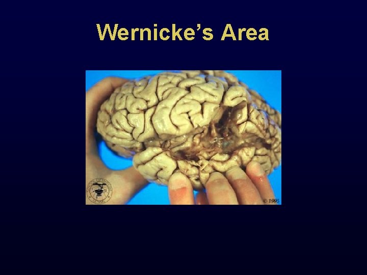 Wernicke’s Area 