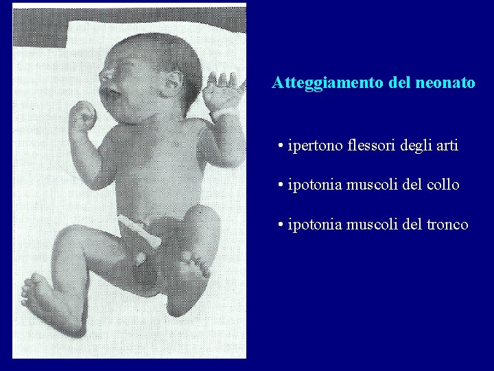 Atteggiamento del neonato • ipertono flessori degli arti • ipotonia muscoli del collo •