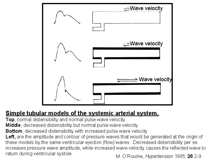 Wave velocity Simple tubular models of the systemic arterial system. Top, normal distensibility and