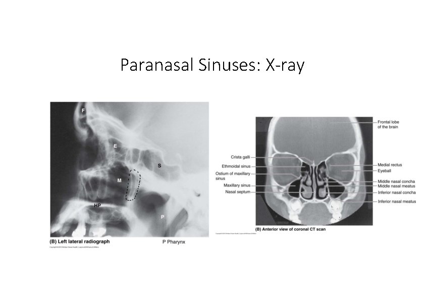 Paranasal Sinuses: X‐ray 