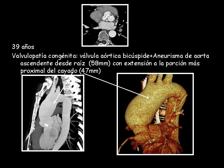 39 años Valvulopatía congénita: válvula aórtica bicúspide+Aneurisma de aorta ascendente desde raíz (58 mm)