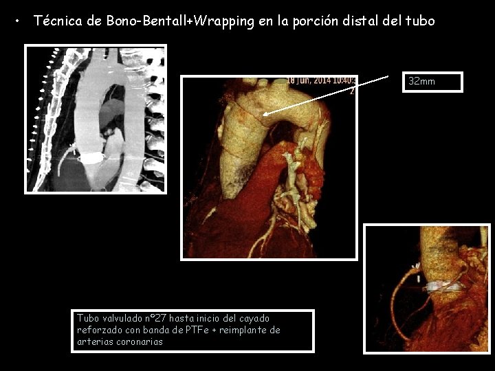  • Técnica de Bono-Bentall+Wrapping en la porción distal del tubo 32 mm Tubo