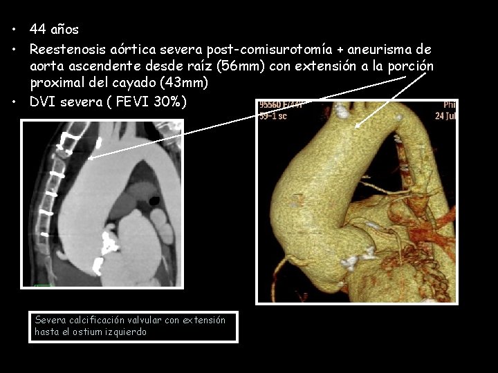  • 44 años • Reestenosis aórtica severa post-comisurotomía + aneurisma de aorta ascendente