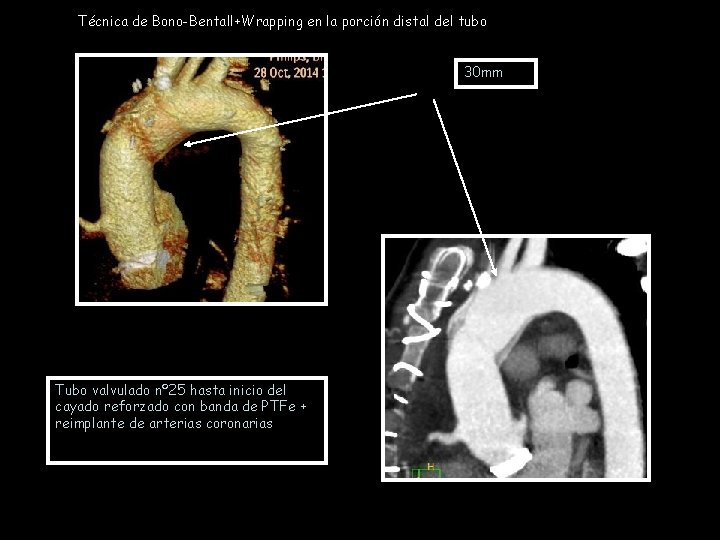 Técnica de Bono-Bentall+Wrapping en la porción distal del tubo 30 mm Tubo valvulado nº