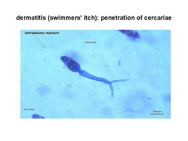 dermatitis (swimmers' itch): penetration of cercariae 