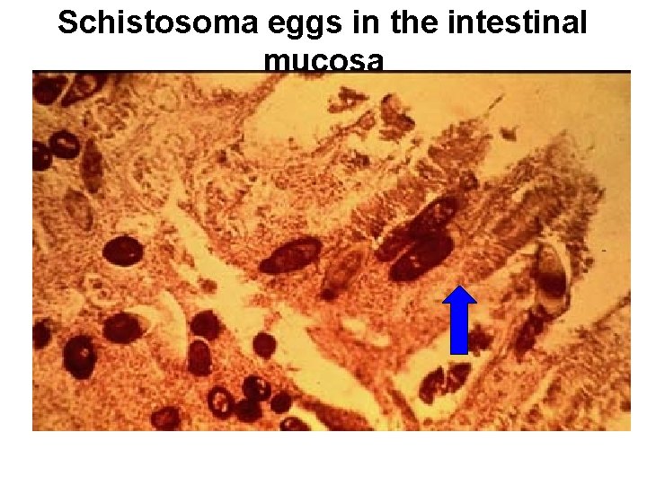 Schistosoma eggs in the intestinal mucosa 