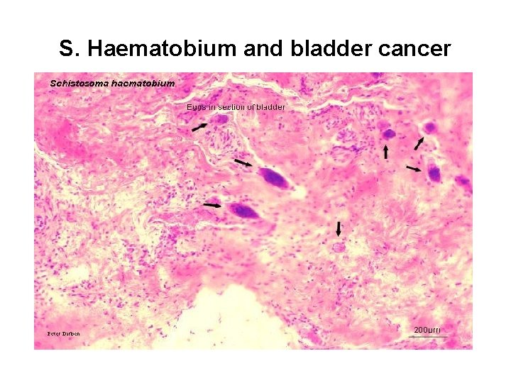 S. Haematobium and bladder cancer 