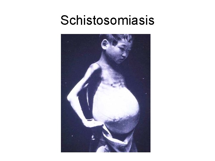 Schistosomiasis 