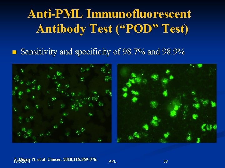 Anti-PML Immunofluorescent Antibody Test (“POD” Test) n Sensitivity and specificity of 98. 7% and