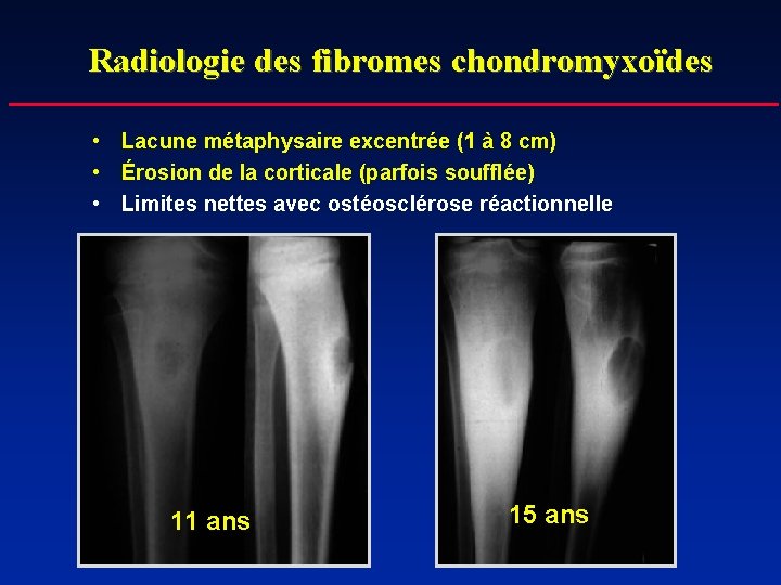 Radiologie des fibromes chondromyxoïdes • Lacune métaphysaire excentrée (1 à 8 cm) • Érosion