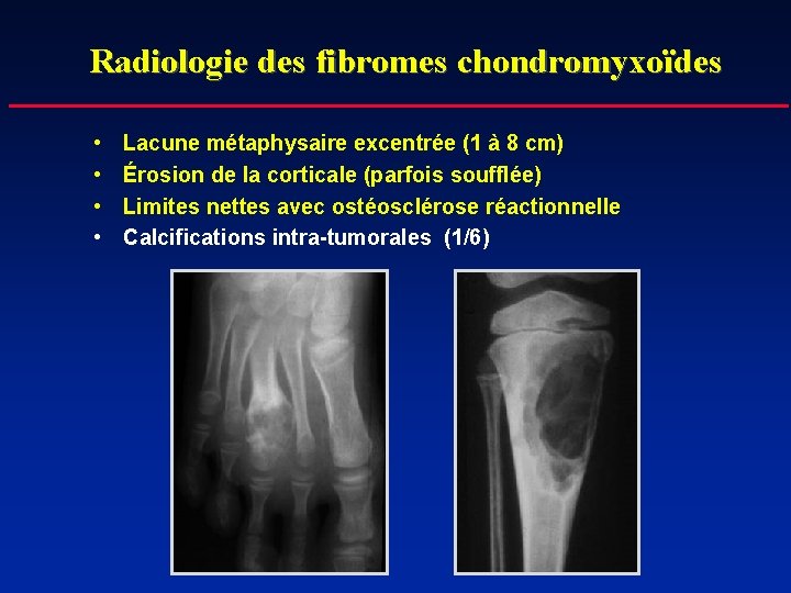Radiologie des fibromes chondromyxoïdes • • Lacune métaphysaire excentrée (1 à 8 cm) Érosion