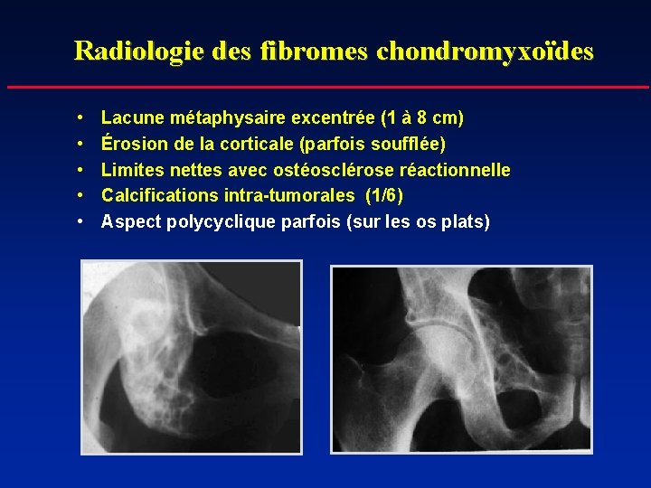 Radiologie des fibromes chondromyxoïdes • • • Lacune métaphysaire excentrée (1 à 8 cm)