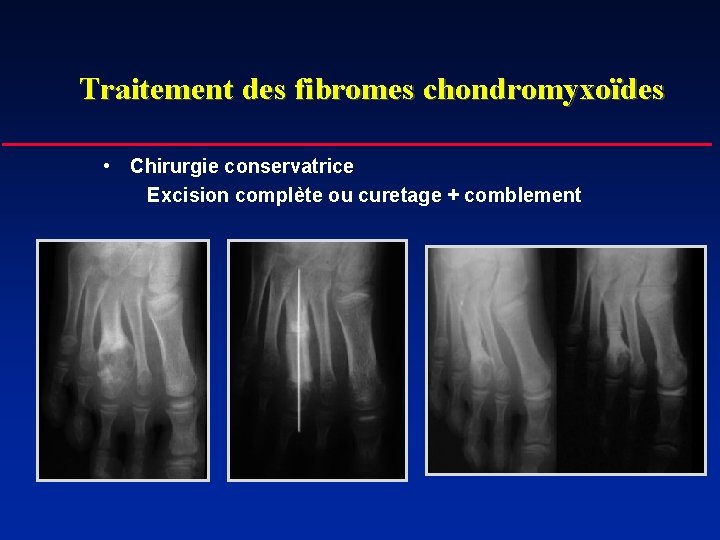 Traitement des fibromes chondromyxoïdes • Chirurgie conservatrice Excision complète ou curetage + comblement 