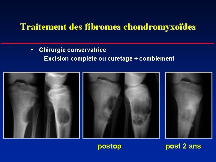 Traitement des fibromes chondromyxoïdes • Chirurgie conservatrice Excision complète ou curetage + comblement postop