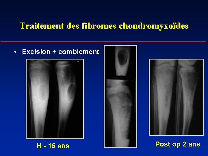 Traitement des fibromes chondromyxoïdes • Excision + comblement H - 15 ans Post op