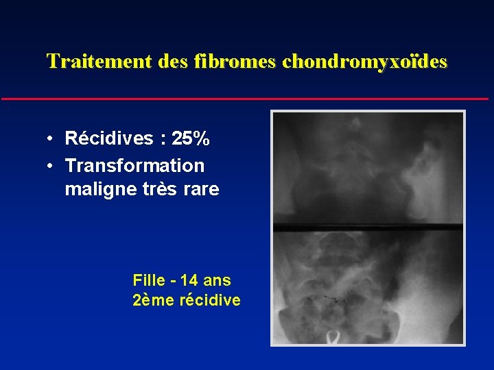 Traitement des fibromes chondromyxoïdes • Récidives : 25% • Transformation maligne très rare Fille