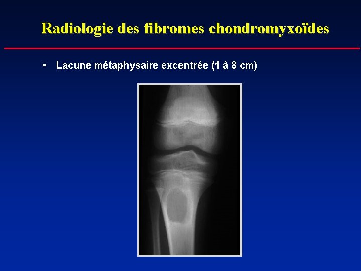 Radiologie des fibromes chondromyxoïdes • Lacune métaphysaire excentrée (1 à 8 cm) 