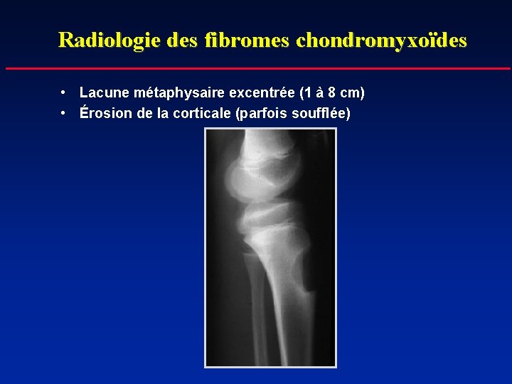 Radiologie des fibromes chondromyxoïdes • Lacune métaphysaire excentrée (1 à 8 cm) • Érosion