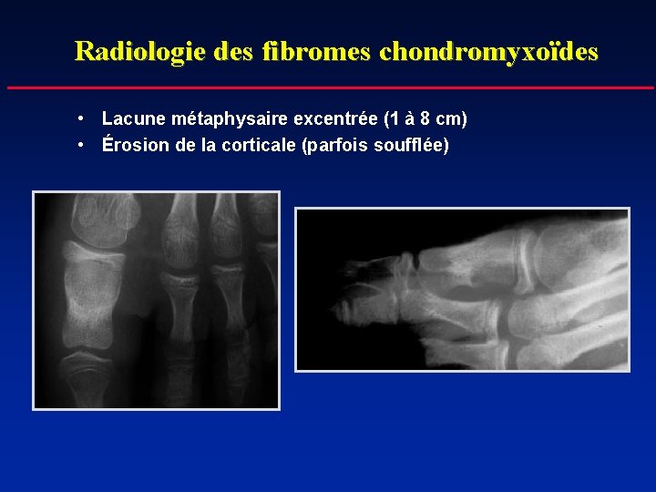 Radiologie des fibromes chondromyxoïdes • Lacune métaphysaire excentrée (1 à 8 cm) • Érosion