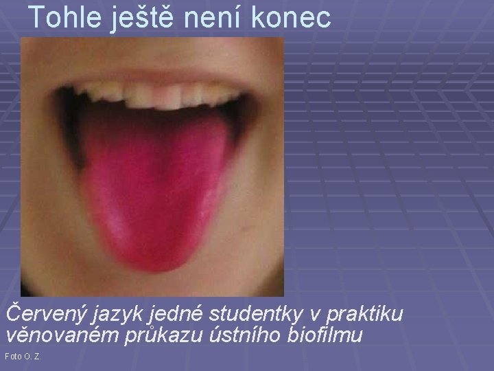 Tohle ještě není konec Červený jazyk jedné studentky v praktiku věnovaném průkazu ústního biofilmu