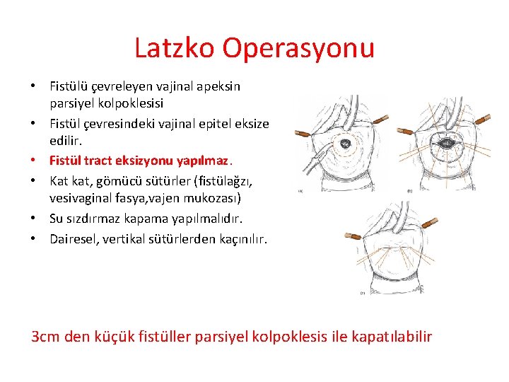 Latzko Operasyonu • Fistülü çevreleyen vajinal apeksin parsiyel kolpoklesisi • Fistül çevresindeki vajinal epitel Latzko Operasyonu • Fistülü çevreleyen vajinal apeksin parsiyel kolpoklesisi • Fistül çevresindeki vajinal epitel