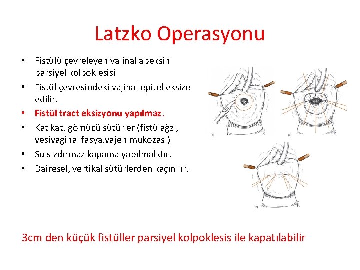 Latzko Operasyonu • Fistülü çevreleyen vajinal apeksin parsiyel kolpoklesisi • Fistül çevresindeki vajinal epitel