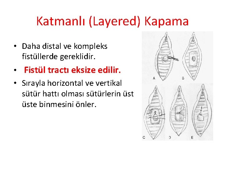 Katmanlı (Layered) Kapama • Daha distal ve kompleks fistüllerde gereklidir. • Fistül tractı eksize Katmanlı (Layered) Kapama • Daha distal ve kompleks fistüllerde gereklidir. • Fistül tractı eksize