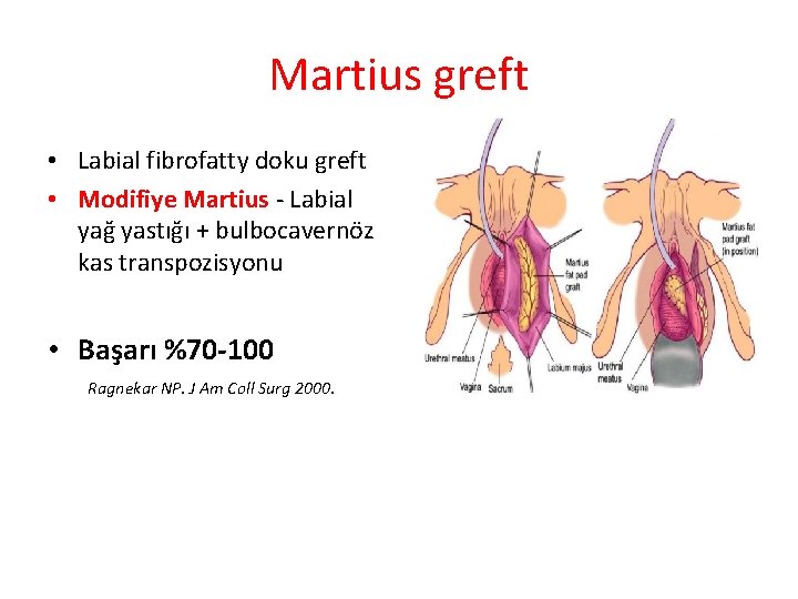 Martius greft • Labial fibrofatty doku greft • Modifiye Martius - Labial yağ yastığı