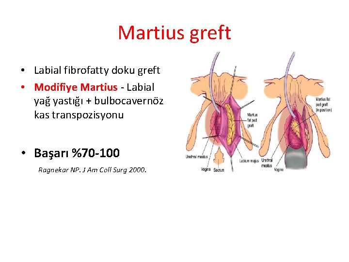 Martius greft • Labial fibrofatty doku greft • Modifiye Martius - Labial yağ yastığı Martius greft • Labial fibrofatty doku greft • Modifiye Martius - Labial yağ yastığı